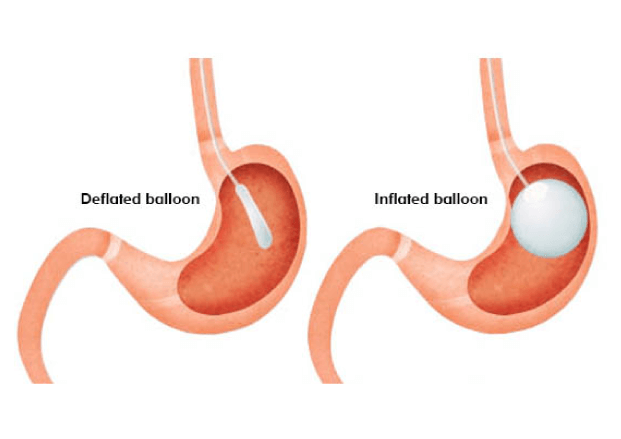 intragastric balloon