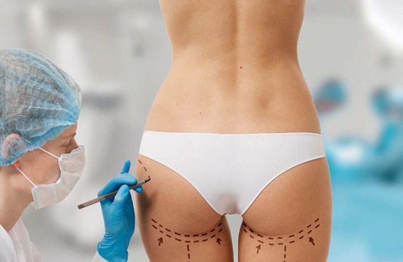 lipoaspiration