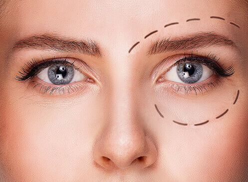 BLÉPHAROPLASTIE