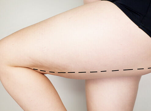 LIFTING DES CUISSES