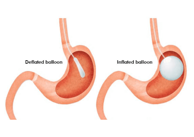Intragastric Balloon