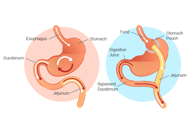 Gastric Bypass (Roux-en-Y)