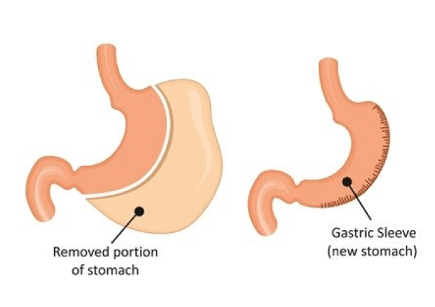 Vertical Sleeve Gastrectomy (VSG)