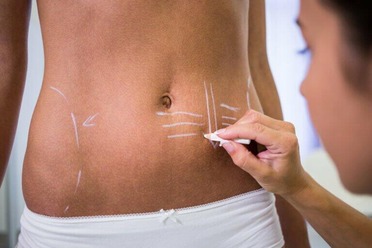 abdominoplasty