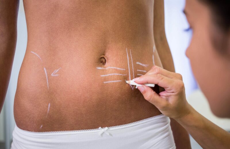 abdominoplasty scaled