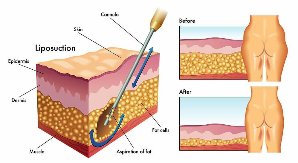Liposuction - body contouring, Clinique La Rose