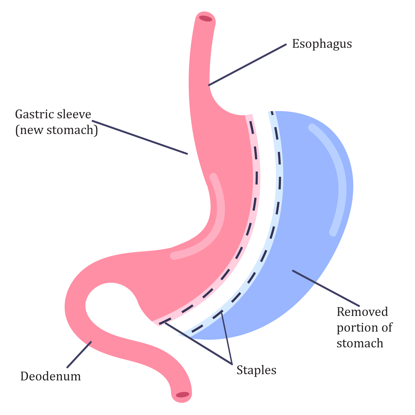 Vertical Sleeve Gastrectomy (VSG) procedure - Clinique La Rose