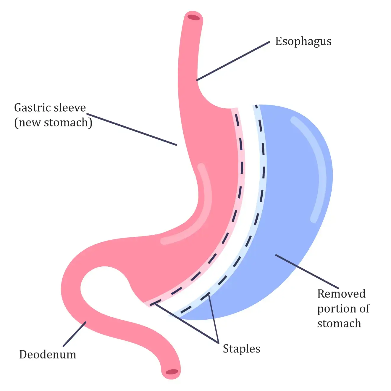 Vertical Sleeve Gastrectomy Weight Loss Surgery LA ROSE Clinic