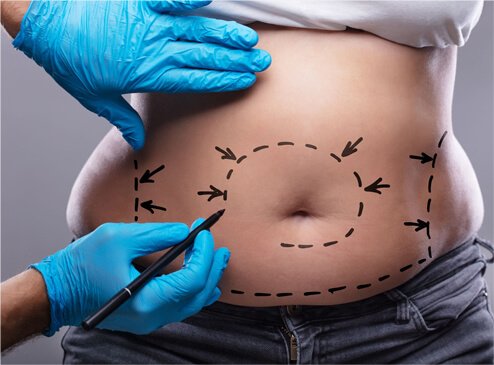 silhouette abdominoplastie 6