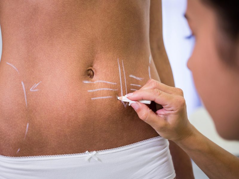 Chirurgie esthétique de la silhouette pour remodeler votre corps 3 Bodylift : la lipectomie de la ceinture pour galber la silhouette