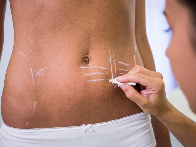 Body contouring in Tunis: pre-operative markings on the abdomen