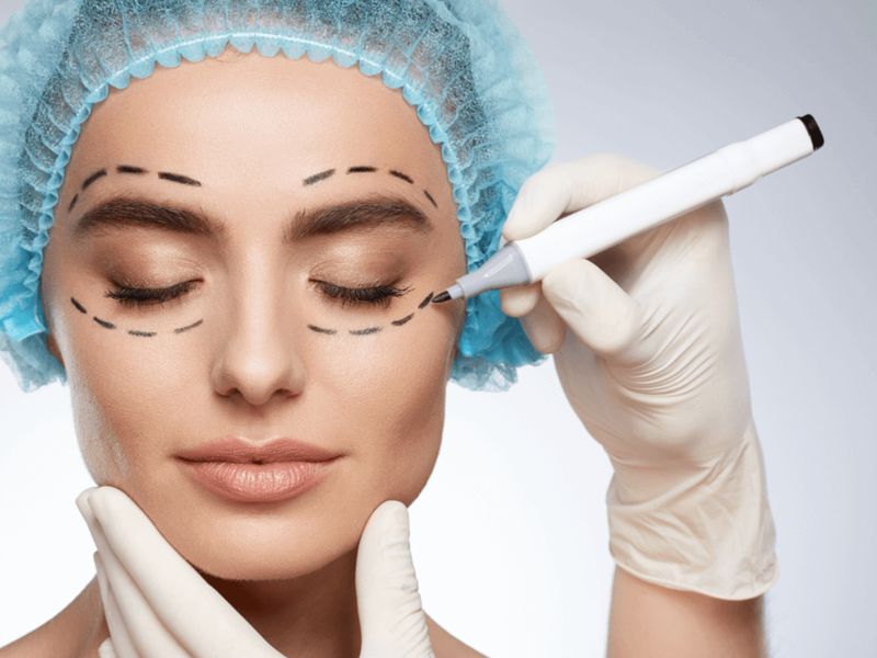 Facial surgery in Tunis: pre-operative facial markings